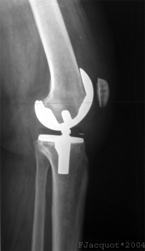 Radiografia de una rodilla con una prótesis