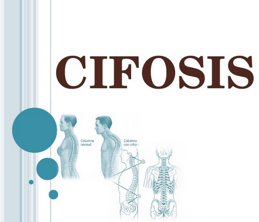 CIFOSIS CIFOSIS