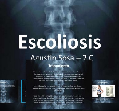 escoliosis escoliosis