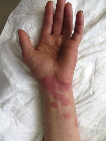 Imaxe dunha reacción alérxica con erupción cutánea