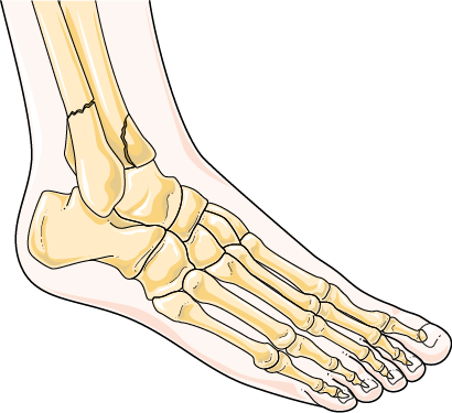 Fractura de ósos no nocello