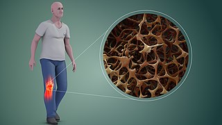 Animación de ósos con osteoporose