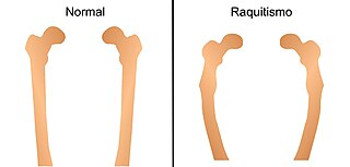 Imaxe de ósos con raquitismo