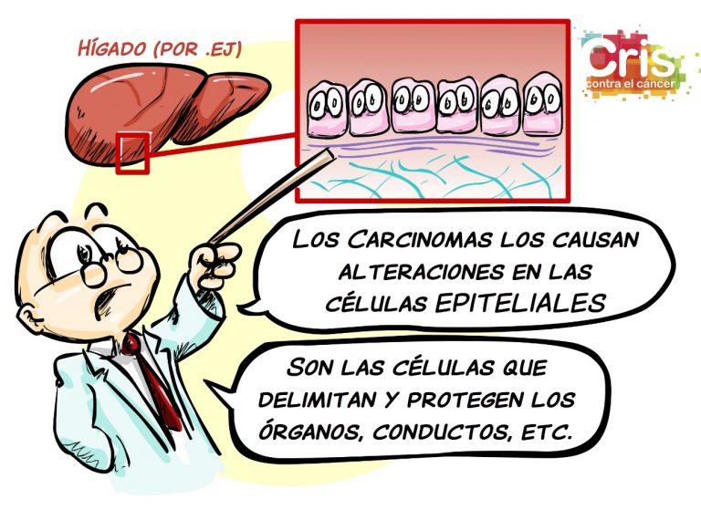 Apoio visual, carcinoma