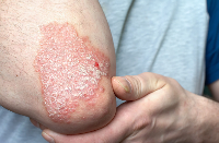 Foto dunha persoa con psoriasis