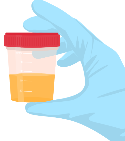 ilustración dunha mostra de urina
