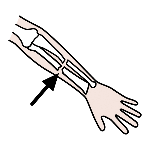 Pictograma de rotura para representar unha lesión