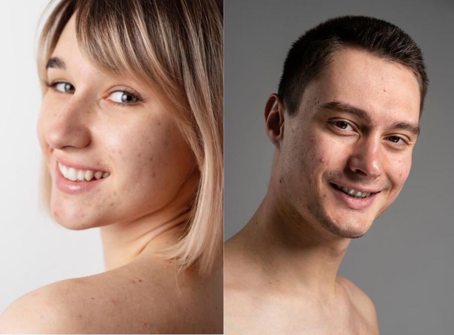Imaxe dunha rapaza e dun rapaz con acne