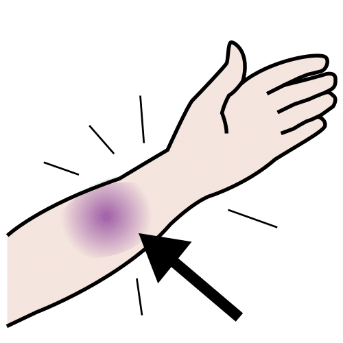 Pictograma que representa un brazo cun hematoma
