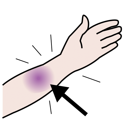 Pictograma que representa un brazo cun negrón