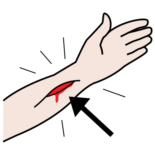 Pictograma que representa unha braza con corte do que sae sangue