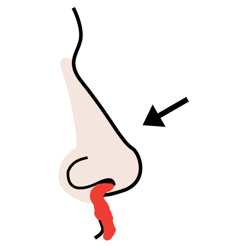 Pictograma que representa unha hemorraxia nasal