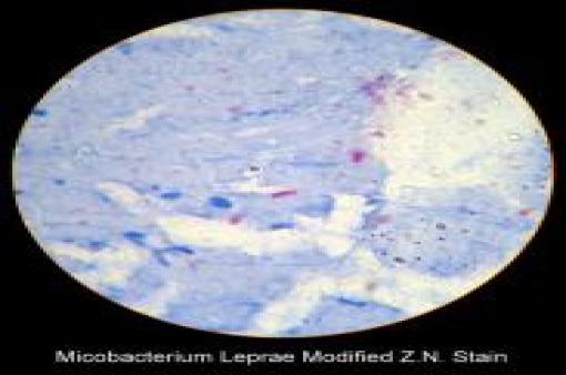 Micobacterium Leprae